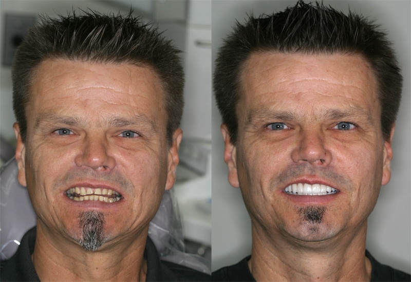 Before and After Reconstructive Dentistry