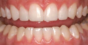 female porcelain veneers patient after treatment