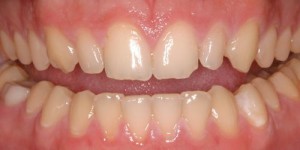 female porcelain veneers patient before treatment