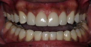 Patient after cosmetic dental work