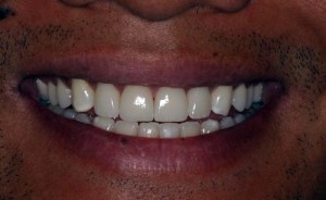 Patient after cosmetic dental work