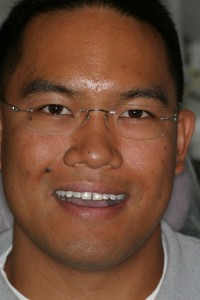 Patient before cosmetic dental work