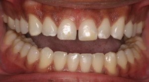Patient before cosmetic dental work