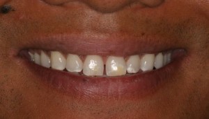 Patient before cosmetic dental work