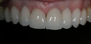 Porcelain Crowns made by master ceramist and periodontal, flapless crown lengthening.