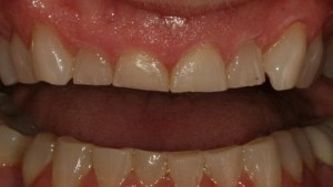 This patient had severe wear and a very gummy smile.