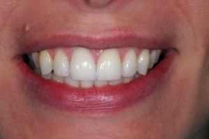 before photo of patient after new Dental crowns