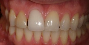 before photo of patient needing Dental crowns
