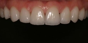 female patient of Dr. Rice in after Porcelain veneers