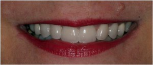 Laser gum lift and dental crowns
