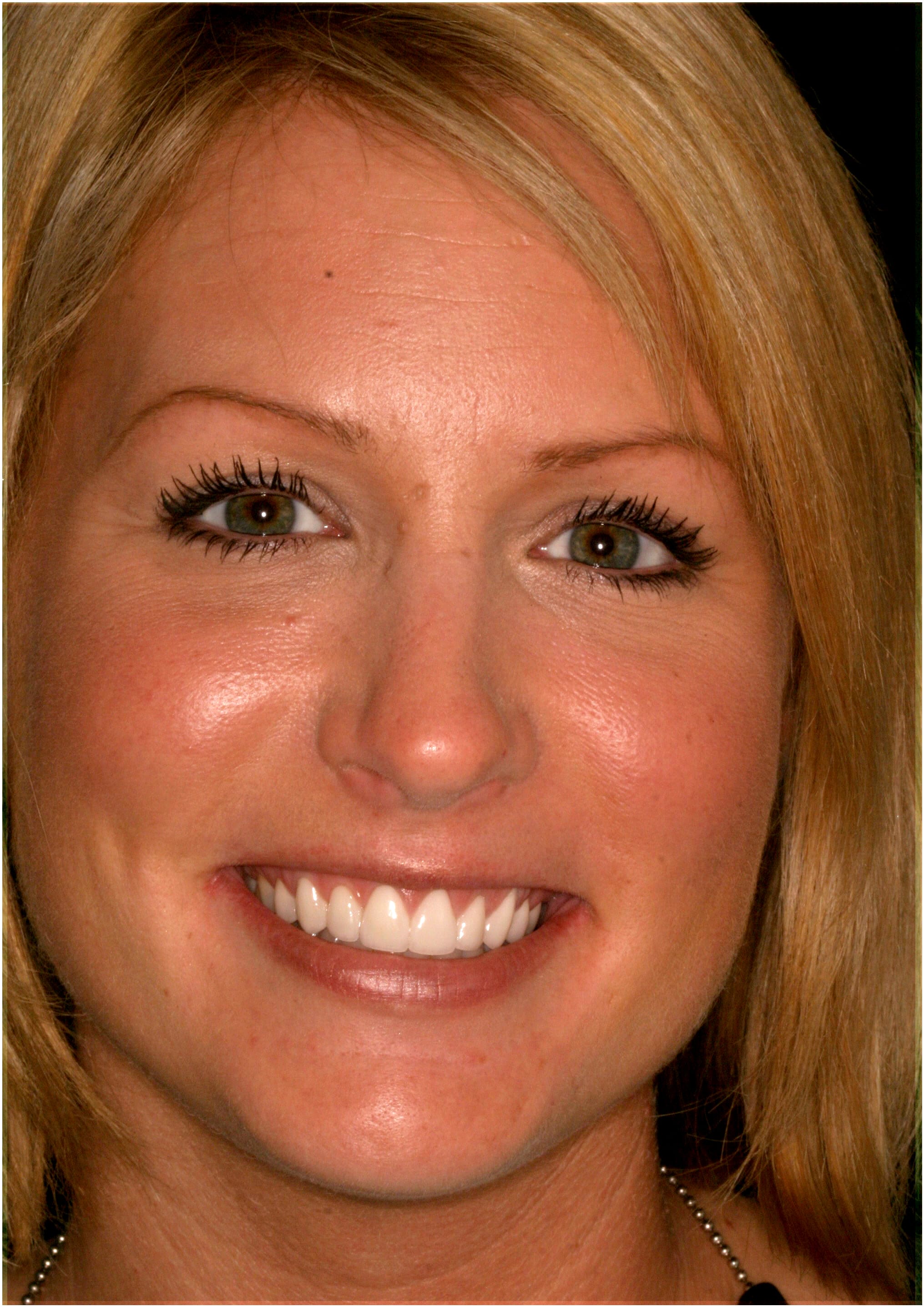 pt-02-after-full After a smile makeover photo of a patient of Dr. Rice