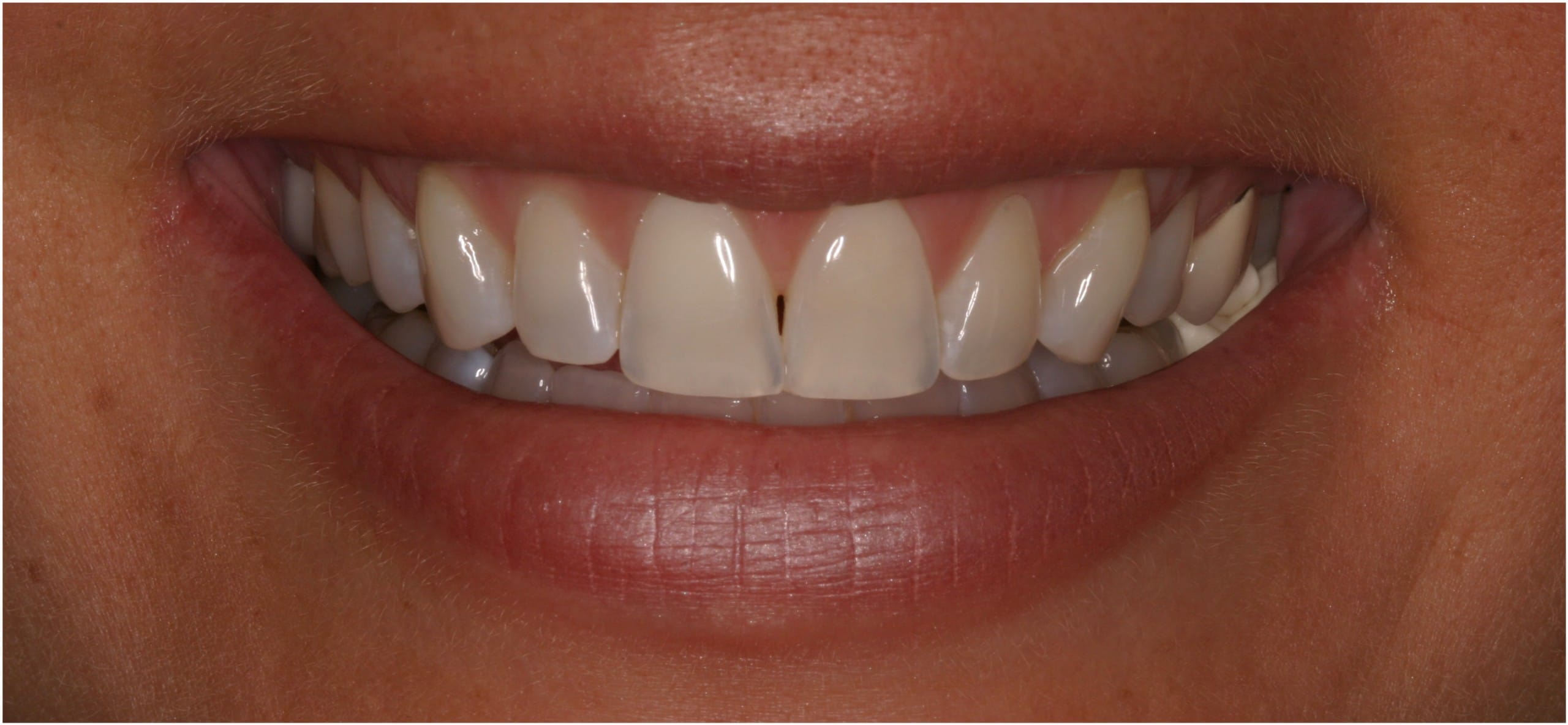 pt-02-before-smile Before smile of a patient seeking help with spaces between her teeth
