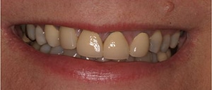 Laser gum lift and dental crowns