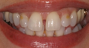 Porcelain Veneers, and chemical/abrasive resurfacing of the enamel on the teeth
