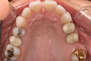 Porcelain Veneers, and chemical/abrasive resurfacing of the enamel on the teeth