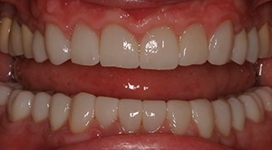 Treatment was Full Mouth Reconstruction in just a few visits