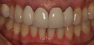 old crowns showing gum inflammation