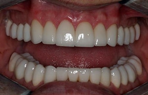 TMJ treatment with Full mouth reconstruction, Porcelain crowns, Porcelain Veneers.