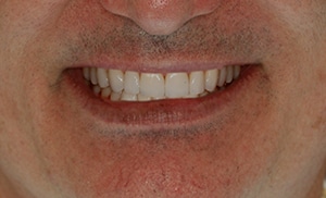 Six Month Smiles orthodontics, and a full mouth reconstruction.