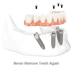 All-on-4 dentures support a full arch of teeth on only 4 implants