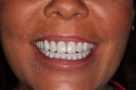 female patient of Dr. Rice shows her smile after all on 4 dental implants