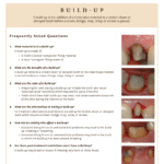 Building up a tooth from decay before putting in a crown