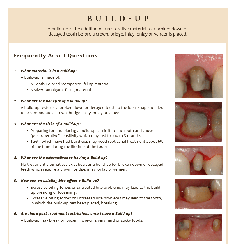 Building up a tooth from decay before putting in a crown