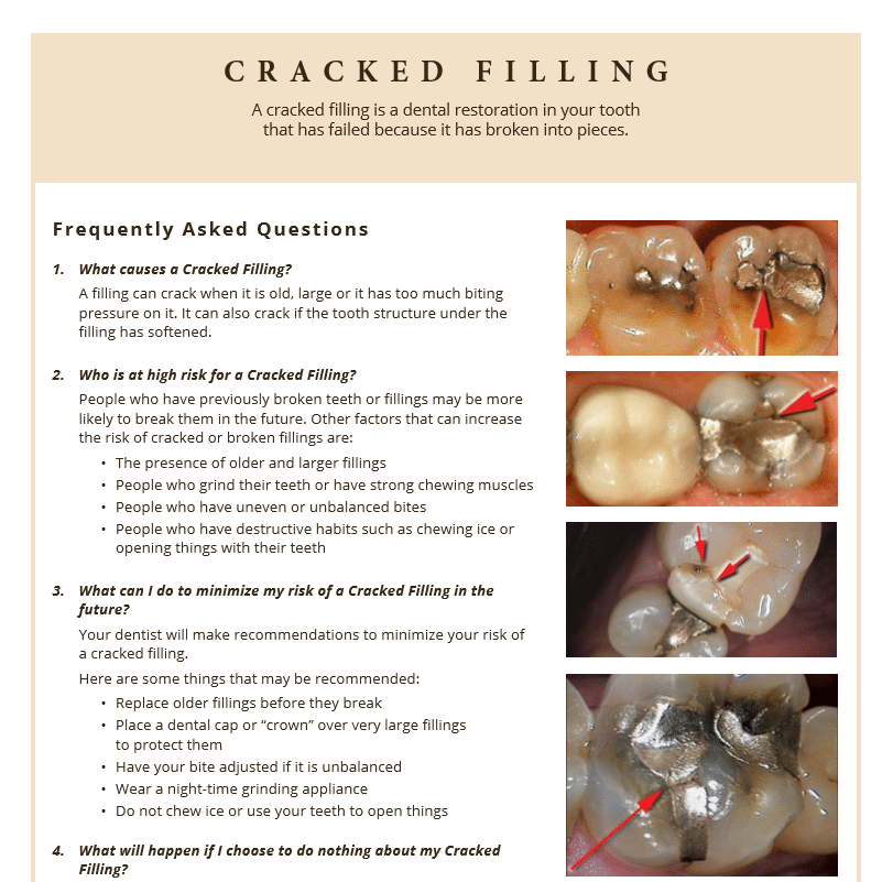 Information on cracked fillings and how to minimize risk