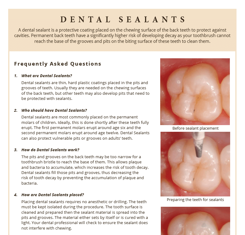 Flyer showing information on dental sealants