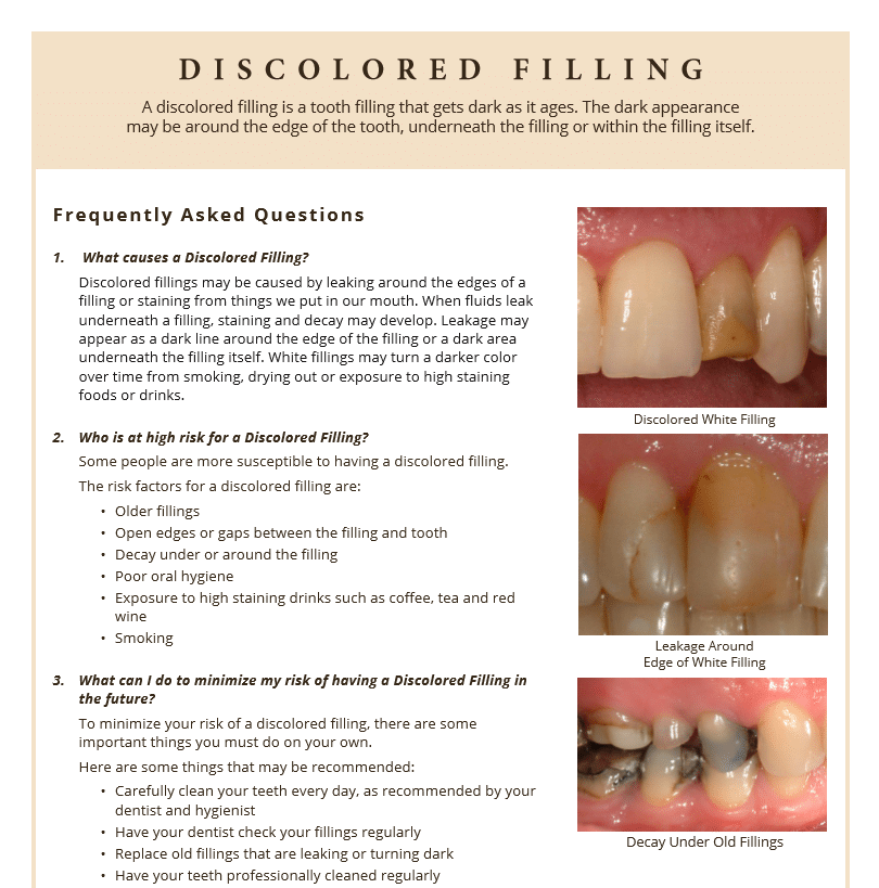 Discolored fillings FAQ