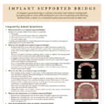 Implant Supported Bridges, materials and alternatives FAQ's