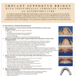 Implant Supported bridge faq's