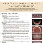 FAQ's on implant supported bridge and alternatives