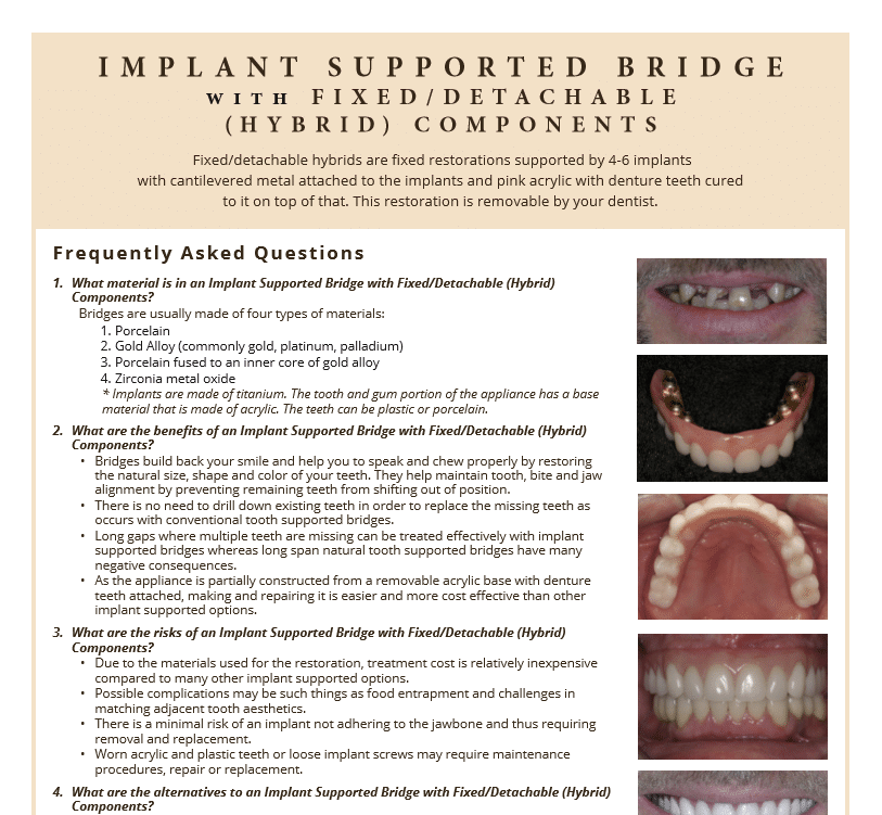 FAQ's on implant supported bridge and alternatives