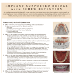 Implant Supported bridge faq's
