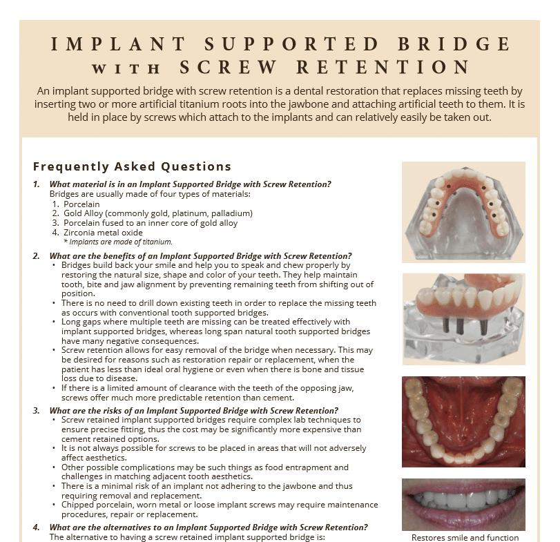 Implant Supported bridge faq's