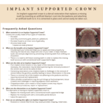 FAQ's on Implant Supported Crowns