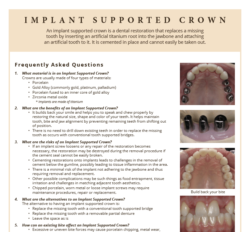 FAQ's on Implant Supported Crowns