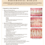 Periodontal Disease information