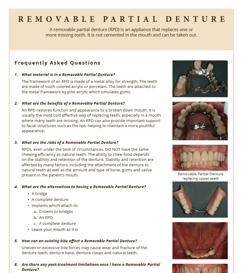 FAQ's for Removable partial denture information