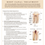 Root Canal treatment FAQ's