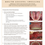 Swelling and affect of mouth lesions