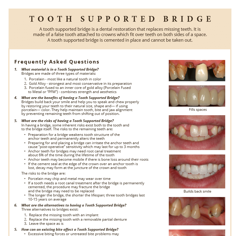 Tooth support bridge information