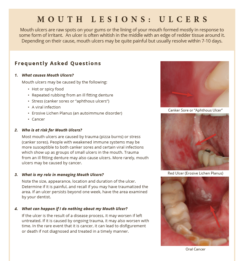 Mouth lesions and ulcers and managing their risks