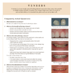 Frequently asked questions about dental veneers
