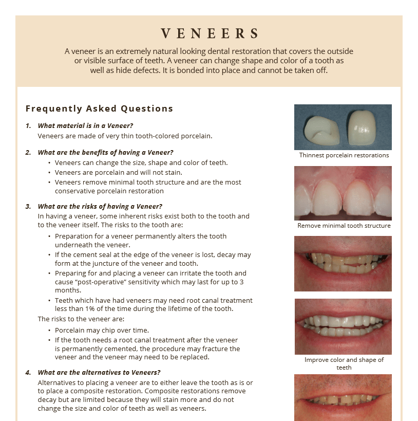 Frequently asked questions about dental veneers