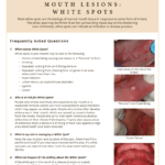 Questions and answers about white spots and mouth lesions