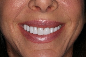 A patient of Dr. Rice's new smile after dental veneers