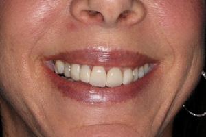 A dental veneer smile before treatment with Dr. Rice