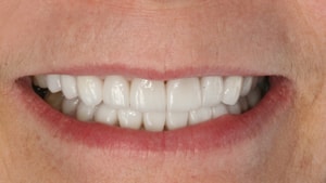After smile of a patient of Irvine Cosmetic Dentist Dr. Rice